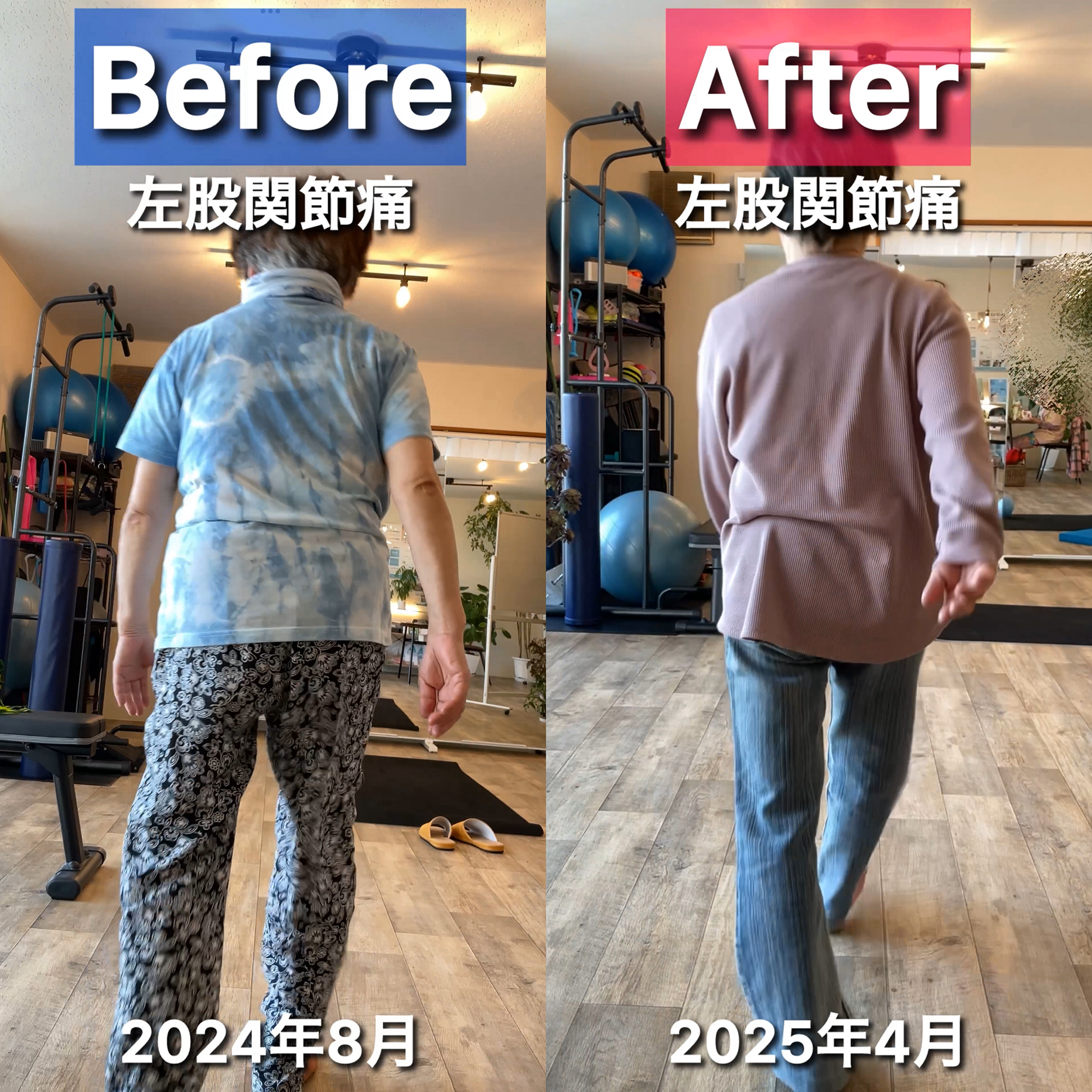 【施術例紹介】人工股関節を避けたい！股関節痛(変形性股関節症)と向き合う女性の回復ストーリー